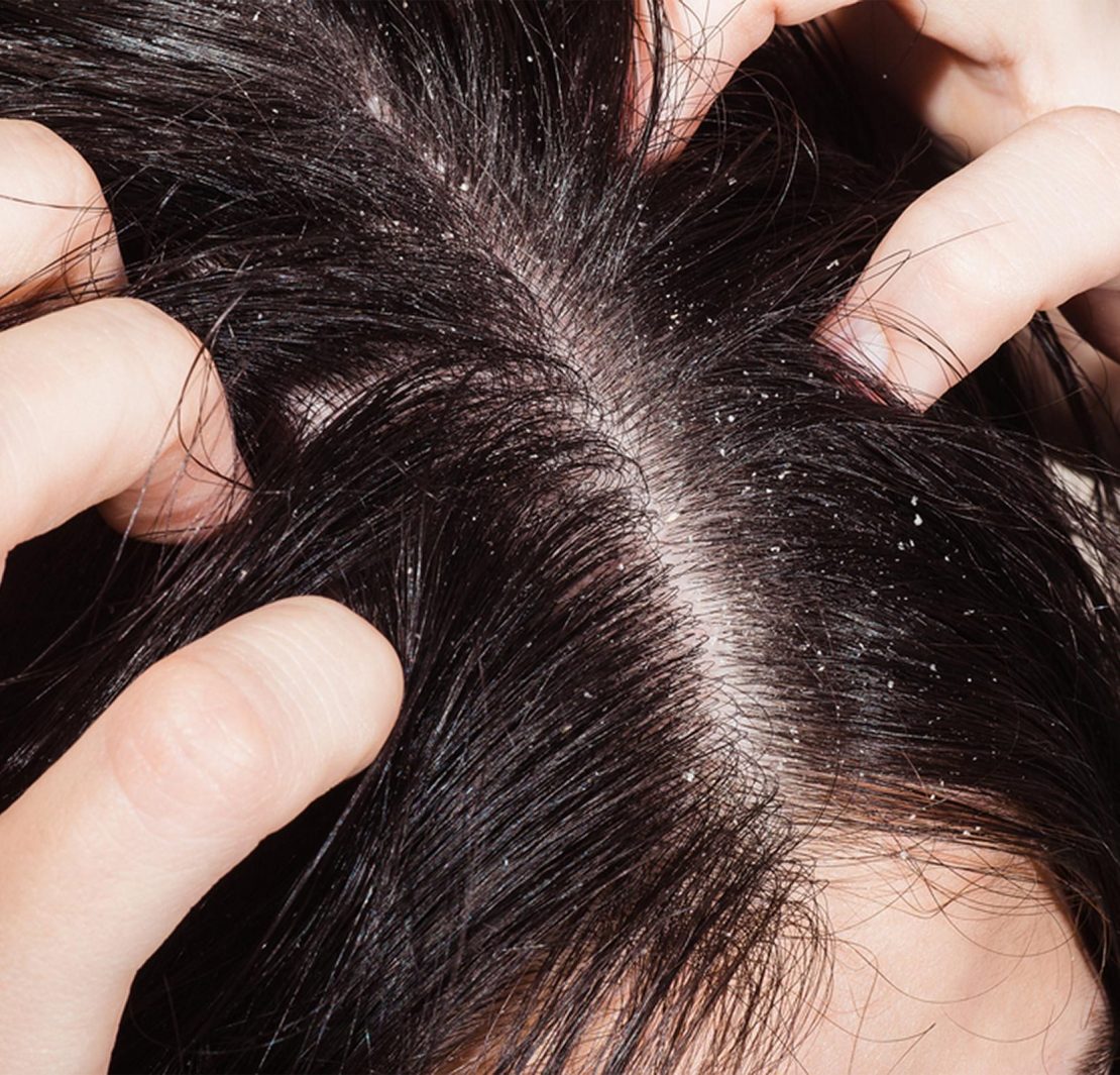 démangeaison cuir chevelu remede naturel