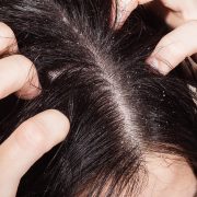 démangeaison cuir chevelu remede naturel