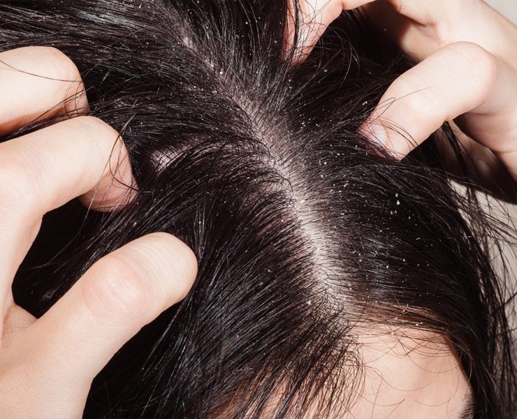 démangeaison cuir chevelu remede naturel